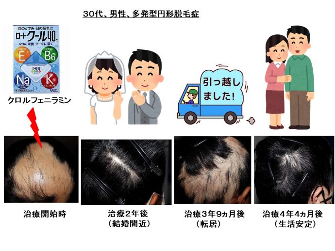 円形脱毛症　病院